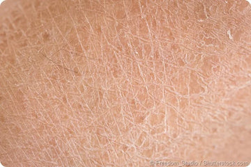 Dry Skin