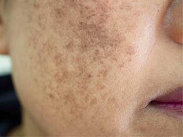 Pigmentation & Dark Spots