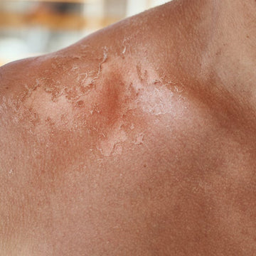 Sun Damage and Tanning